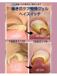 巻き爪ケア2本