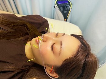 加島鍼灸接骨院/【水素美容鍼】