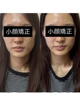 ルピナス 立川店/小顔矯正