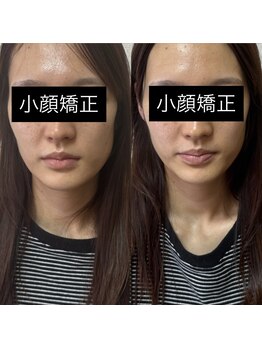ルピナス 立川店/小顔矯正