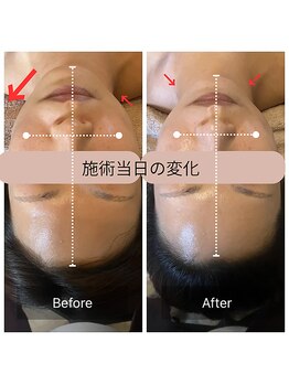 ルーツ(Roots)/小顔矯正