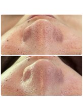 肌質改善サロン　Humming skin【3/2 NEW OPEN（予定）】/ハーブピーリング/毛穴ケア