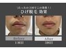 【新規限定】人気No.1★顎下まで綺麗にしたい!ヒゲ+首脱毛 2980円