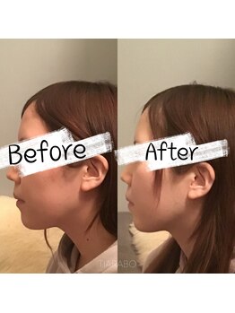 ティアラボ(TIARABO)/贅沢小顔スペシャル