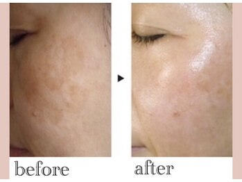 シンデレラ しみケア(Cinderella)/シミケアプログラム