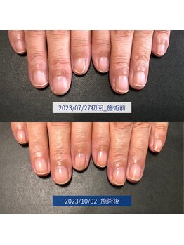 ブラン(blanc)/3.自爪育成