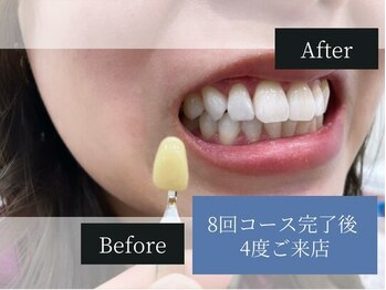 ホワイトニングカフェ 原宿店/◎歯のホワイトニング施術写真◎