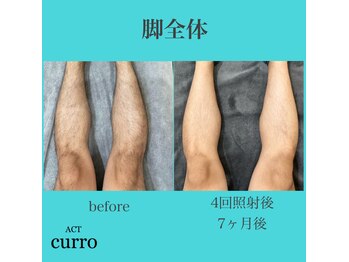 アクト クロ(ACT curro)/【脚全体】脱毛施術例