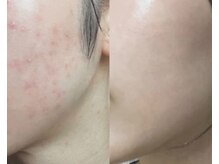 ルミエール シーサイド(L’MIERE seaside)/長年の肌荒れを根本改善1