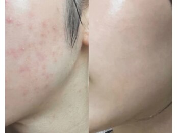 ルミエール シーサイド(L’MIERE seaside)/長年の肌荒れを根本改善1