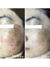 パールホワイトニングサロン 大和店/難しいシミも一気に改善