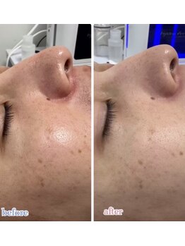 サロンドプレマージュ(Salon de Premage)/ハイドロ/ビフォーアフター