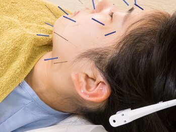 いなほ はりきゅう整骨院 東新宿/美容鍼施術/手順3