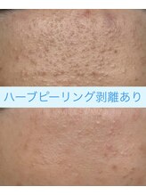 ソアン(Soin)/ハーブピーリング剥離あり3回