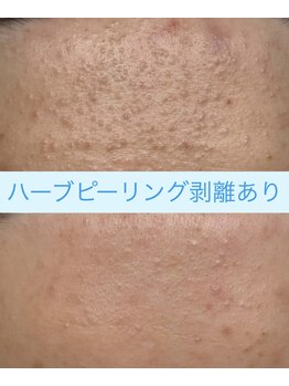 ソアン(Soin)/ハーブピーリング剥離あり3回