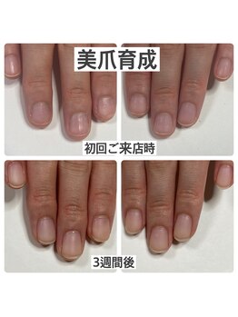 マニュコクーン(ManuCocoon)/爪育成 深爪 巻き爪 大阪市