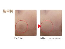 エム(M)/シミケアで若々しい素肌へ♪