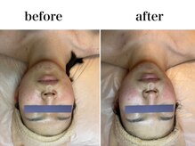 KMB 中崎町店/毛穴洗浄×光フェイシャル