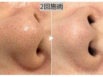 ロワ(Roi)/【毛穴洗浄+引き締め】2回施術