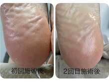 ロンディネ(Rondine)/韓国最新角質ケア・s-planing