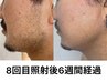 【毎日の面倒な髭剃りを無くす！】メンズヒゲ脱毛 ¥8,000→¥5,000
