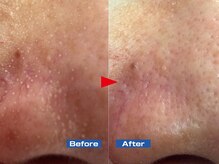 シロ(CHILO)/ハイドラ　before　after　１