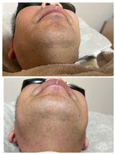 シャイニースキン(Shiny skin)/ヒゲ脱毛で老け顔予防