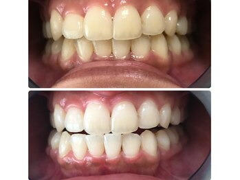 グリッター ショウナン(glitter. SHONAN)/歯のホワイトニングbefore/after