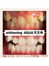 アクア 天王寺店(AQUA)/セルフホワイトニング/天王寺