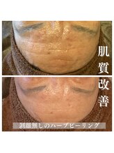 ソーレ(Sole)/陶肌トリートメント