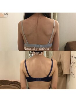 ヴィーナス(Venus)/バストアップで美整骨アプローチ