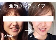 エステサロン ベルジュール/全顔(目元・頬・顎下・おでこ)