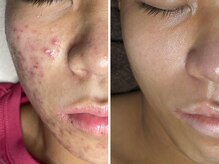 ソワラ(Soiela)の雰囲気（《プラズマ》ニキビケア・肌荒れも"みるみる"陶器肌へ☆）