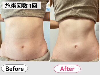 ハロ(Halo)/腸もみマッサージ・腸セラピー