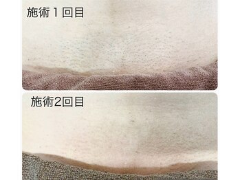 カピリナ(kapilina)/VIO脱毛ハイジニーナ