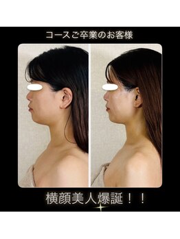 真美(Sinbi)/リターン横顔ビフォーアフター