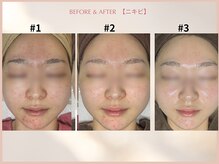 シンスプラス(SINCE+)/ニキビ集中改善コース