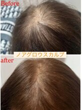 ニューユー(NewYou)/ノアグロウスカルプ