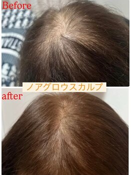 ニューユー(NewYou)/ノアグロウスカルプ