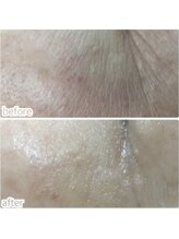 ホワイトニングショップ 大阪枚方店/REVIハーブピーリング