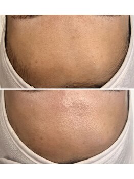 ホワイトワックス 京都四条烏丸(WHITE WAX)/《全顔》フェイシャルワックス