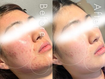 セルフミー 恵比寿(SELF Me...)/ハーブピーリング/ニキビケア