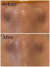 モテ 新宿店(Mote)/ハイドラ毛穴洗浄＋艶肌Wax 新宿