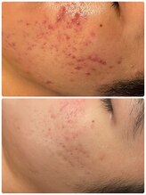 くつろぎ処癒家/ニキビ集中ケア