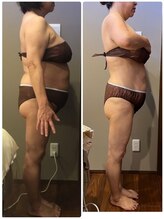 ムーン(MOON)/痩身3ヶ月の変化