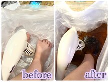 プレデト(PreDeto)/重金属デトックスマシン施術終了