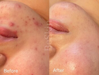 ビースキン 藤沢店(BeSkin)/ホルモンバランスによる顎ニキビ