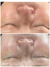 リノベル(LINOBELLE)/肌質改善ならハーブピーリング