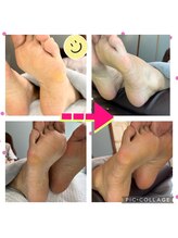 Dr.ネイル爪革命 静岡沼津店/胼胝ケア