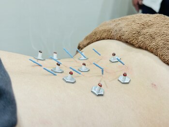 はぴねす鍼灸整骨院 天六院/鍼灸風景2